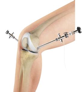 Knee Keyhole Surgery Cheshire | Chondroplasty | Microfracture