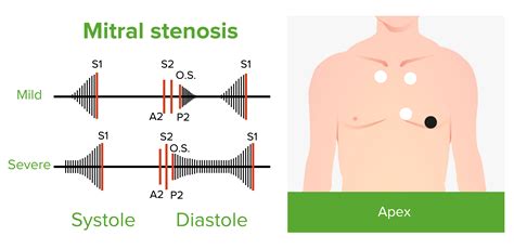 Estenosis Mitral | Concise Medical Knowledge