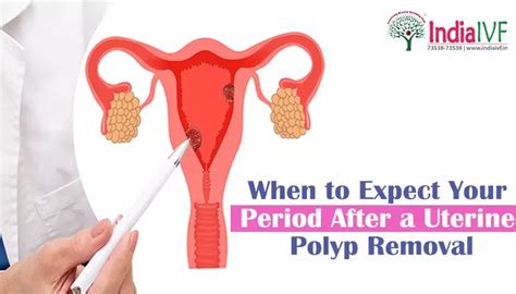 When to Expect your Period after a Uterine Polyp Removal