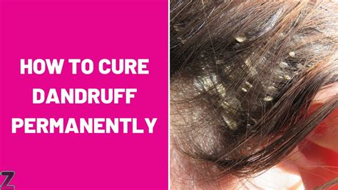 How To Cure A Dandruff - Showerreply3