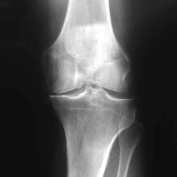 Icd 10 Code For Degenerative) Primary Osteoarthritis Of Right Shoulder.