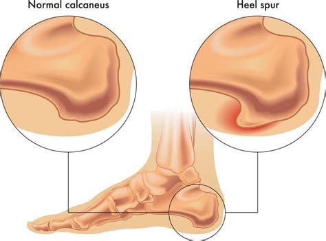 How Do Heel Spurs Develop?: InStride Queen City Foot and Ankle Specialists: Podiatrists