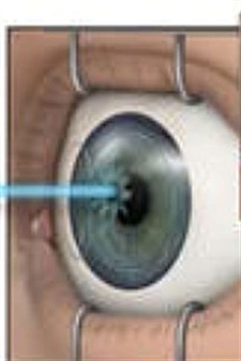 Lasik Enhancement Procedure