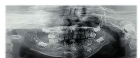 Panoramic radiograph of the patient showing severe mandibular ...