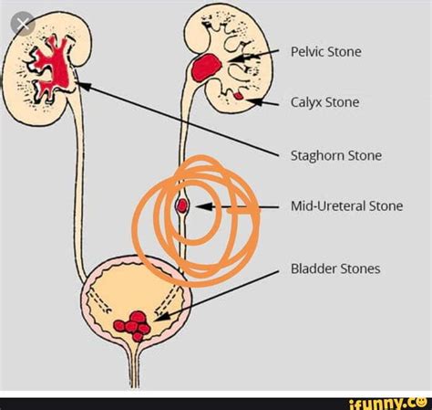 Pelvic Stone Calyx Stone Staghorn Stone Mid-Ureteral Stone Bladder Stones - iFunny