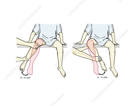 External-internal hip rotation exam - Stock Image - C021/1033 - Science ...