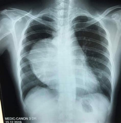 VIETNAMESE MEDIC ULTRASOUND: CASE 578: CYSTIC TERATOMA OF THE LUNG, Dr PHAN THANH HAI, Dr NGUYEN ...