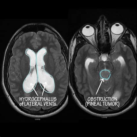 Neuroanatomy Glossary: Hydrocephalus: Obstructive | ditki medical ...