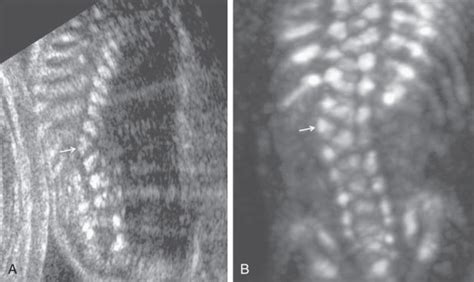 Neural Tube Defects | Radiology Key