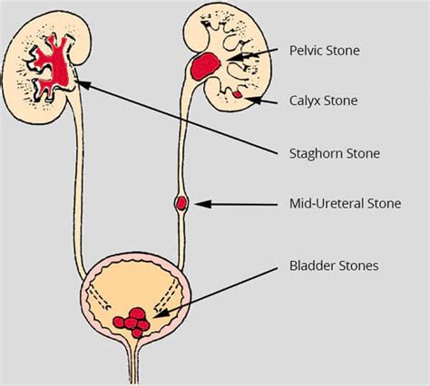 Kidney Stone 4mm