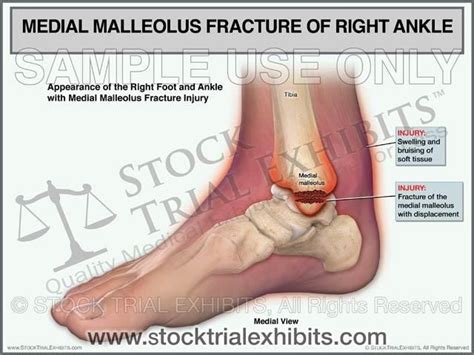 This trial exhibit graphically depicts a medial malleolus fracture ...