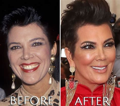 Kris Jenner before and after plastic surgery | Kris jenner plastic ...