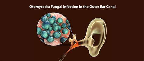 Fungal Otitis Externa