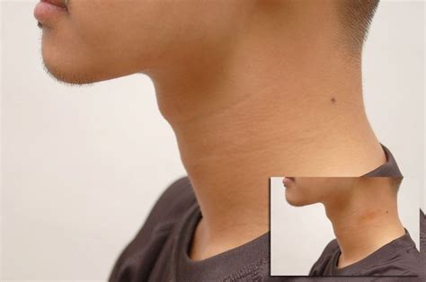 Pin on Hickey Removal Tips