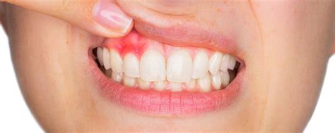 Vacaville Gum Disease Treatment - Vacaville Dental Professionals