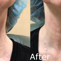 Titan Skin Tightening Procedure | Hartford CT