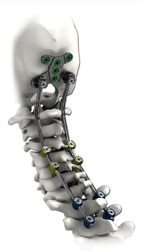 Spine | Implants | Products | Life Sign