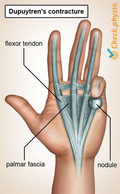 Dupuytren's contracture | Physio Check