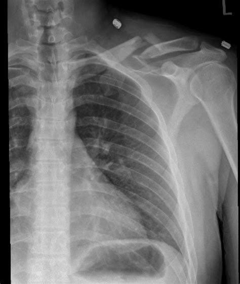 14.1: Clavicle Fracture - Medicine LibreTexts