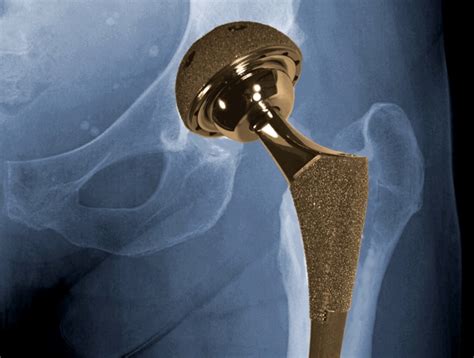 biomet_hip_implant – OrthoFeed