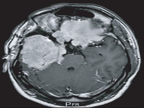 Neuroimaging–MRI ((a–d) with contrast enhancement) shows (a) sphenoid... | Download Scientific ...