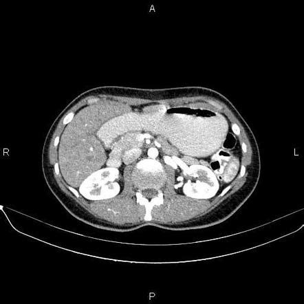 Superior Mesenteric Artery Syndrome Radiology