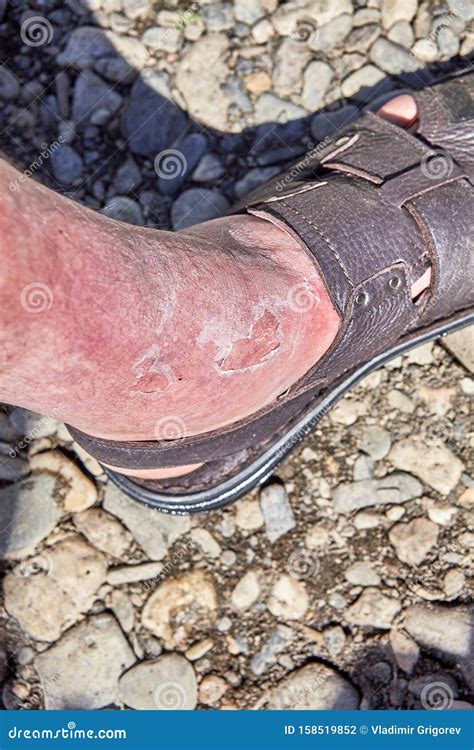 Irritation of the Skin Due To Sunburn Stock Photo - Image of burn, dermatitis: 158519852