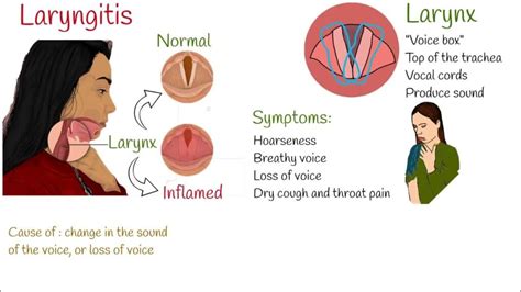 Understanding Laryngitis: Causes, Symptoms, And Treatment - Ask The ...