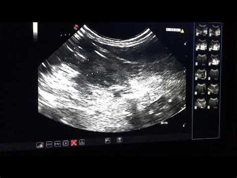 Ultrasound guided core Liver Biopsy - YouTube