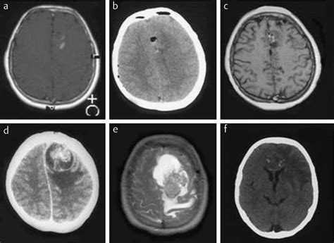 Neuroimaging of the patient-MRI before the initial surgical procedure a ...