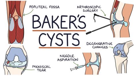 Understanding Baker's Cysts (Popliteal Cysts) - YouTube