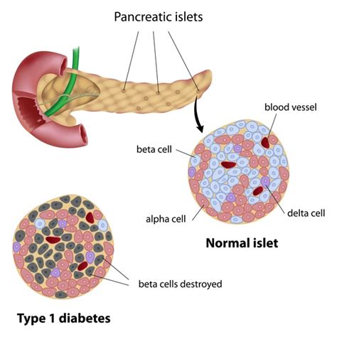 Type 1 Diabetes Symptoms, Causes, Preventions And Cure