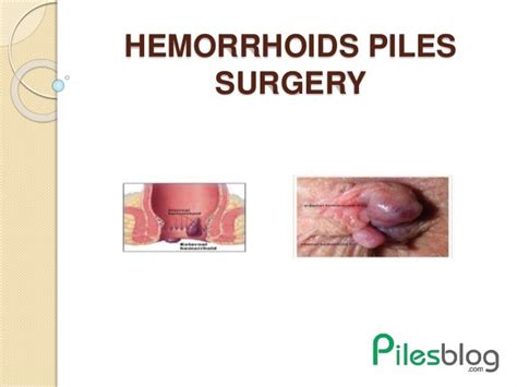 Haemorrhoids piles surgery Available