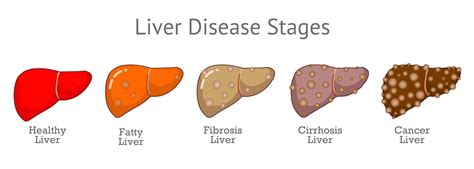 How does fatty liver disease (NAFLD) progress?