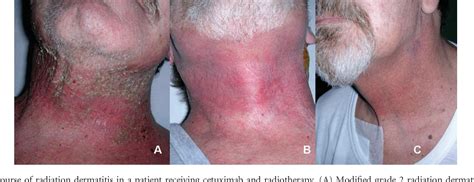 Radiation Dermatitis Grading