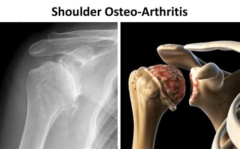 Arthritis – Cambridge Shoulder