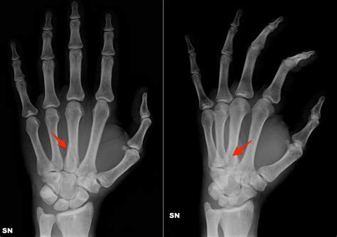 Third Metacarpal Fracture | coachingultrasound