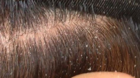 Dandruff Removal / Dandruff Extreme / Dandruff Scratching ASMR / Dandruff Treatment at Home #39 ...