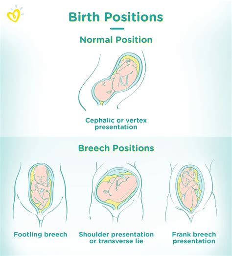 Breech Baby Meaning, Causes And Birth Pampers