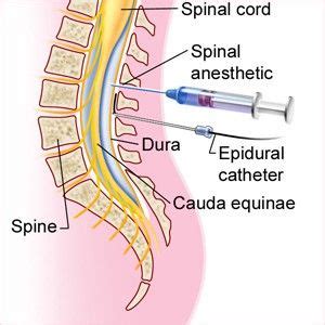 Spinal Block Vs Epidural