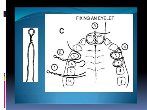 Various intermaxillary fixation techniques