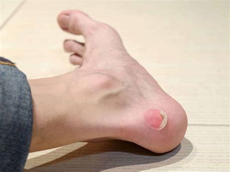 6 Easy Ways to Prevent Foot Blisters + What to Do if It's Too Late