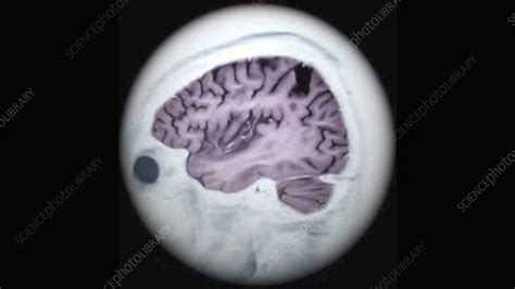 Brain atrophy, 3D MRI scan - Stock Video Clip - K005/5749 - Science Photo Library