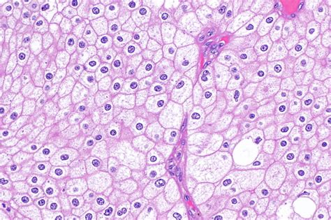 Pathology Outlines - Chromophobe type, renal cell carcinoma