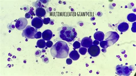 Multinucleated giant cell - YouTube