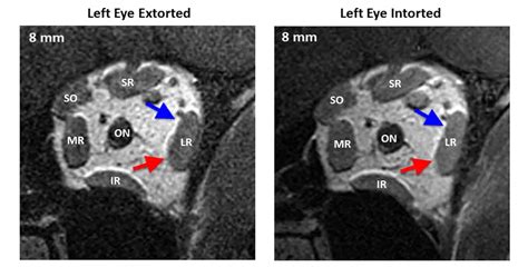 6th Cranial Nerve Palsy Mri