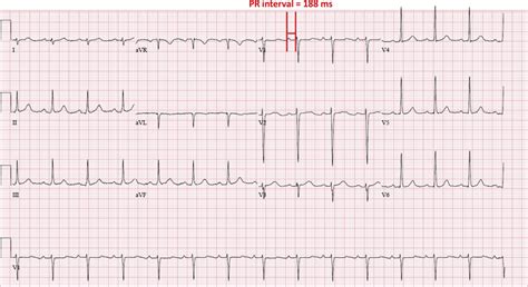 Normal Sinus 12 Lead Ecg