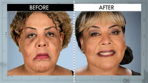 Sagging Face from Botched Patients Before and After: Shocking Transformations! | E! News