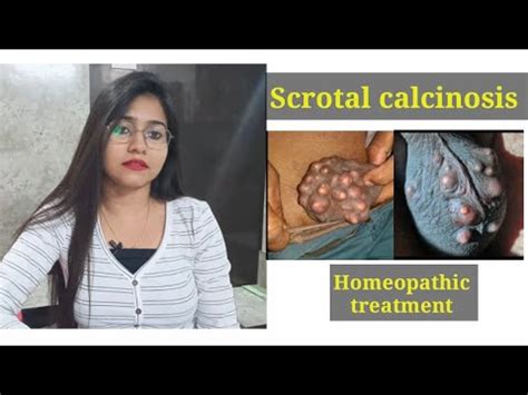 Scrotal calcinosis homeopathic treatment!! Scrotal calcinosis symptoms ...