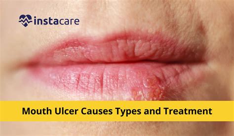 Mouth Ulcer Causes, Types and Treatment